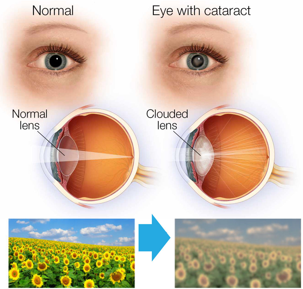 Eye Condition: Glaucoma