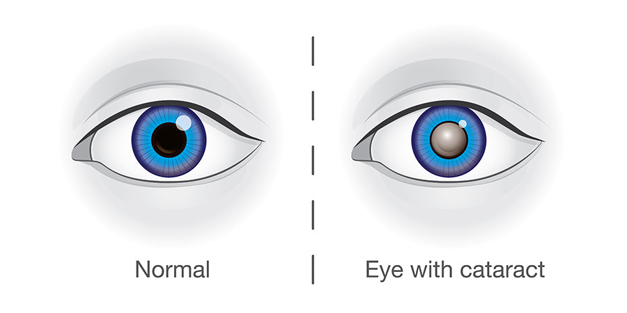 Eye Conditions: Cataracts